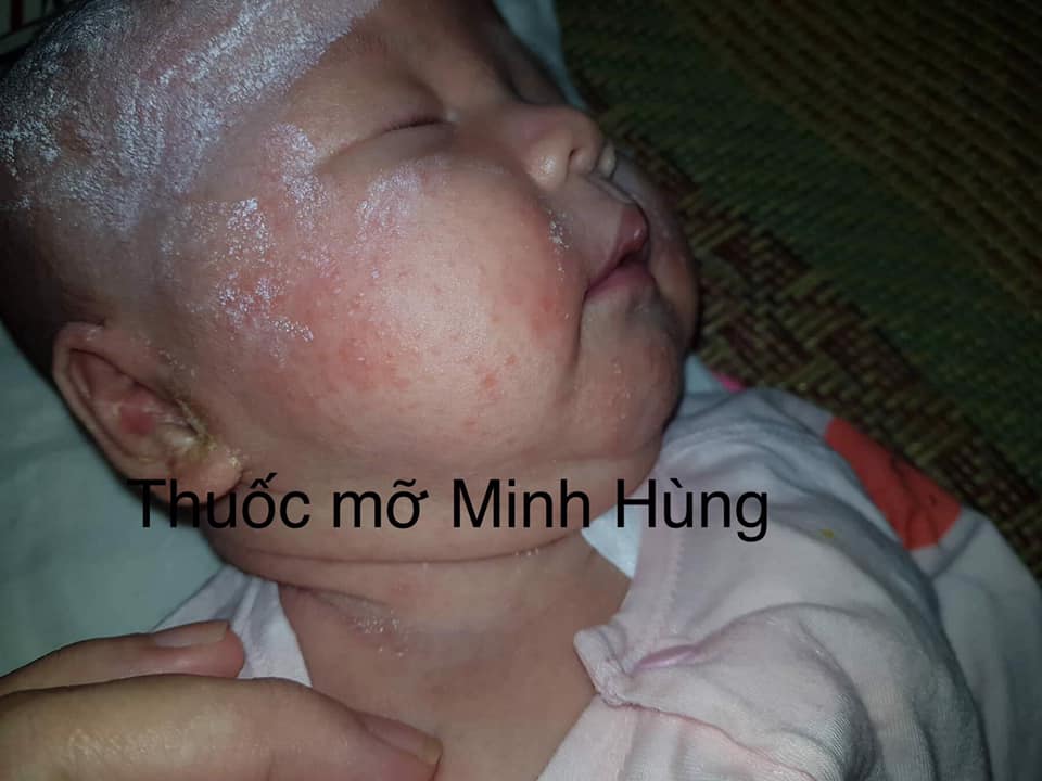 Thuoc Mo Minh Hung