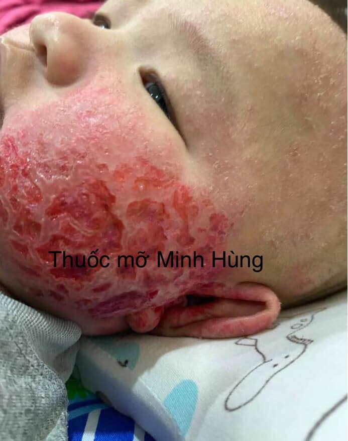 Thuoc Mo Minh Hung 2