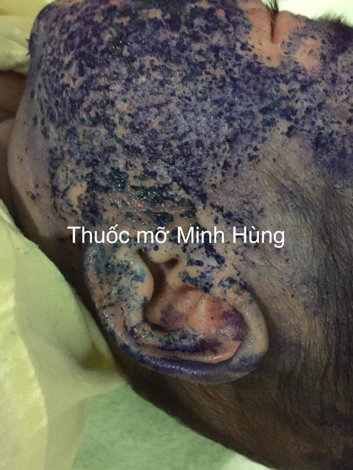 Thuoc Mo Minh Hung 5