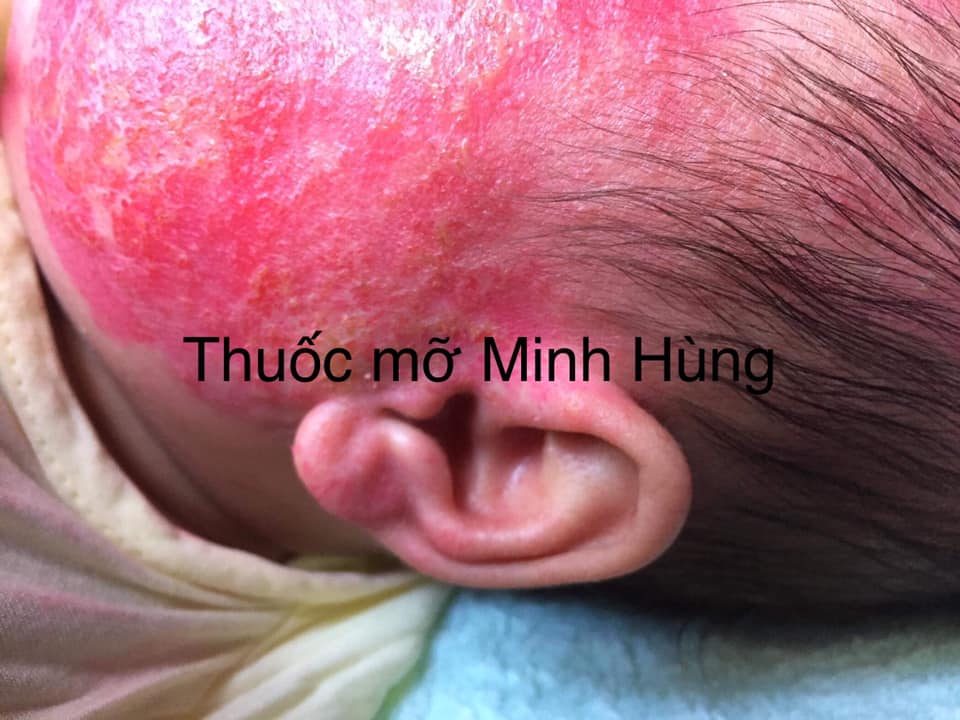 Thuoc Mo Minh Hung 6